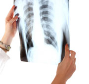 Asbestos Lung